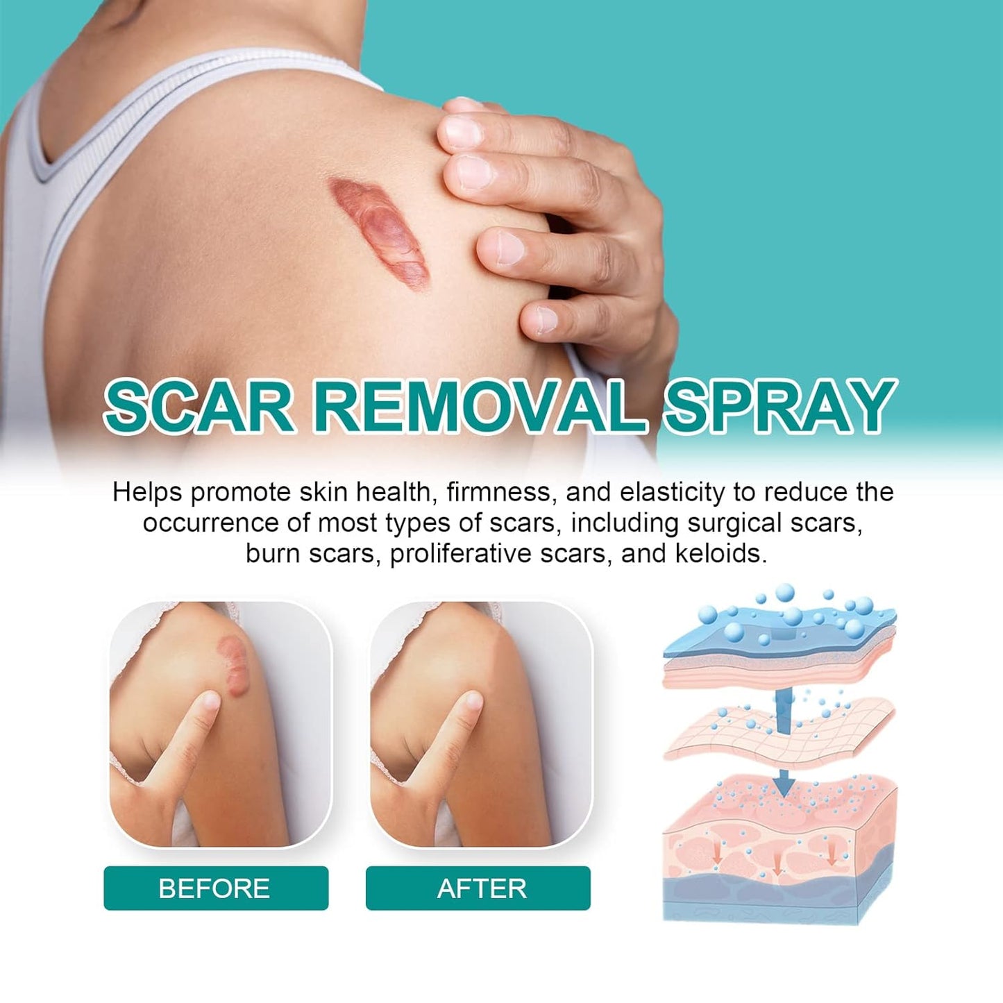 SPRAY PARA CICATRICES Y ESTRÍAS🔬🌟