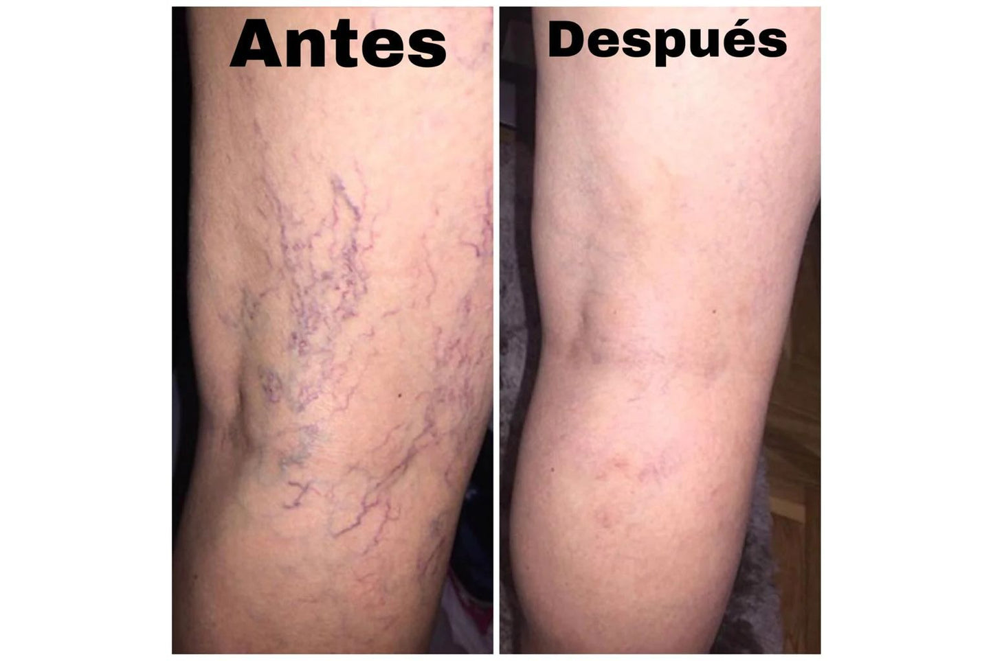 🐝SPRAY VARICOX VEIN - PARA VÁRICES CON VENENO DE ABEJA