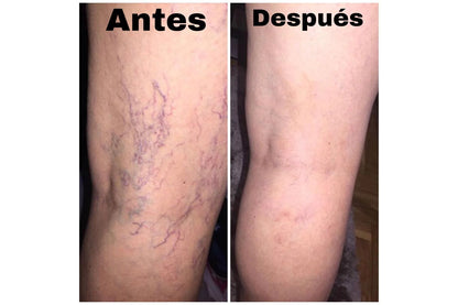 🐝SPRAY VARICOX VEIN - PARA VÁRICES CON VENENO DE ABEJA